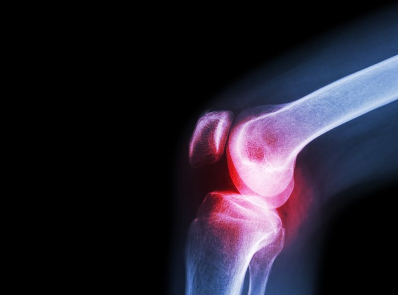 knee-osteoarthritis.jpg